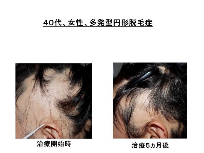 円形脱毛症　病院